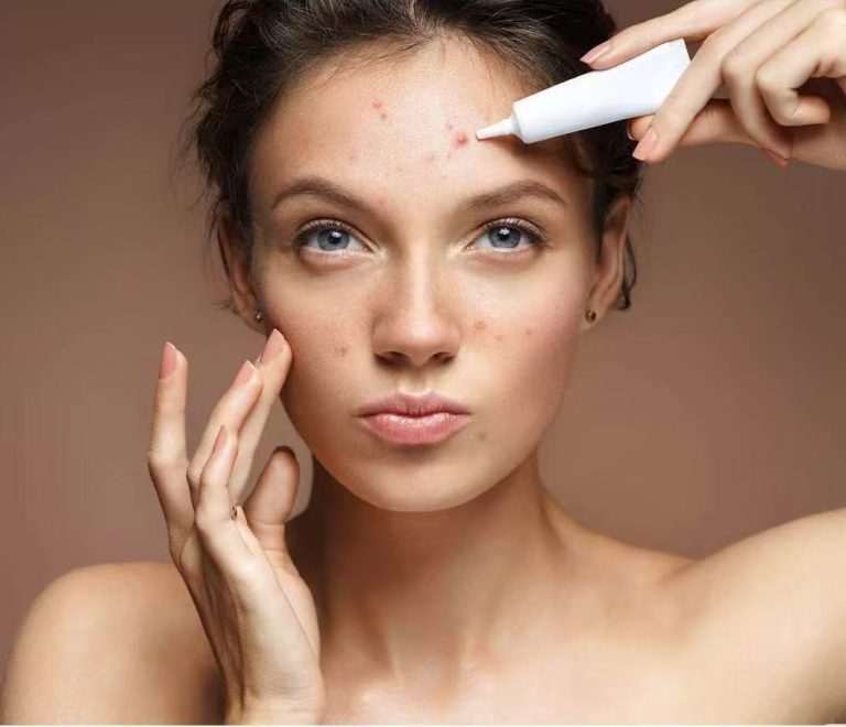Acne Facial